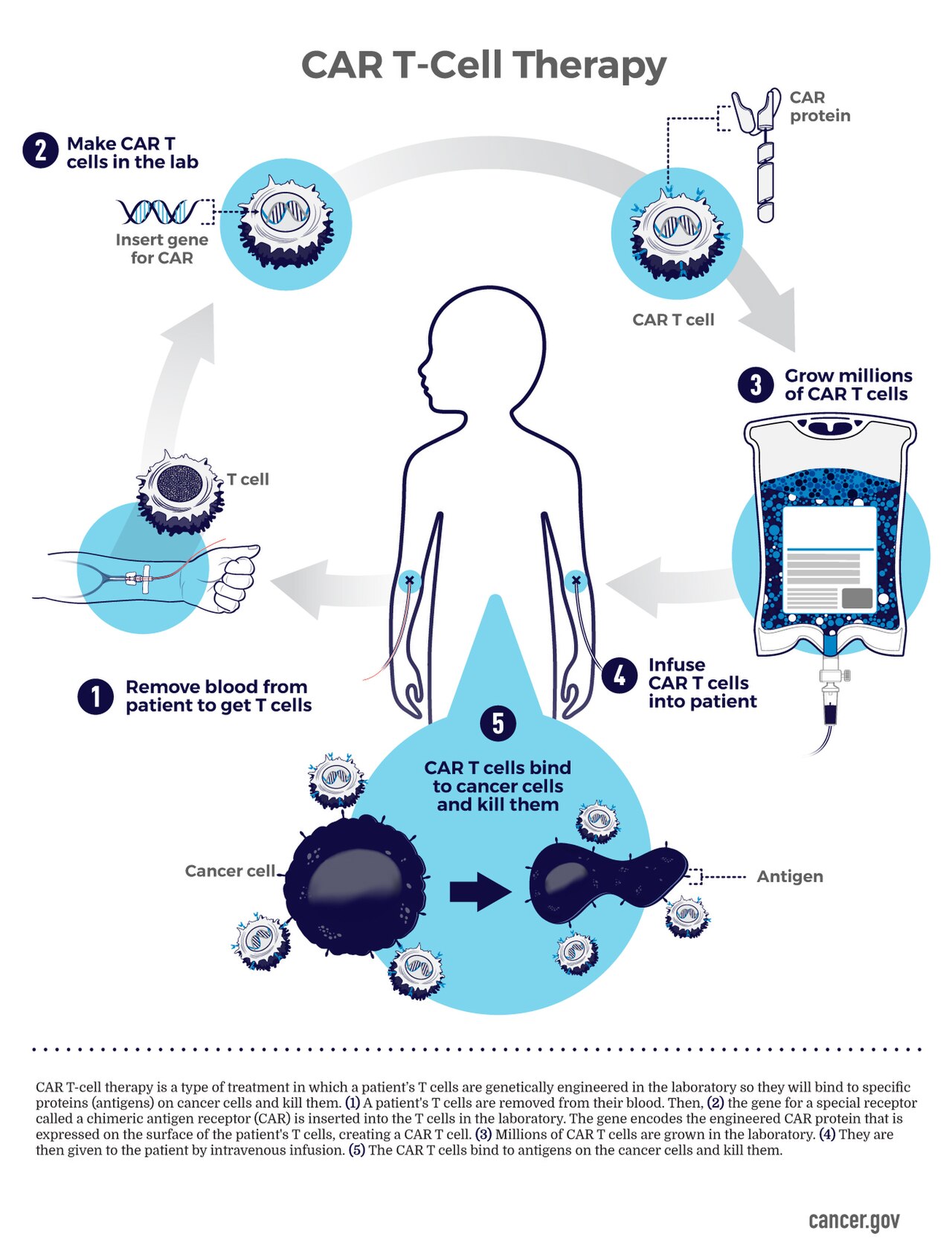 A schematic diagram illustrating the steps of CAR T-cell therapy.